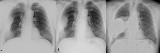 The tumor grew over the course of 22 years after reaching adulthood. (a) Chest X-ray at 50 years old. (b) Chest X-ray at 58 years old. (c) Chest X-ray at 72 years old.