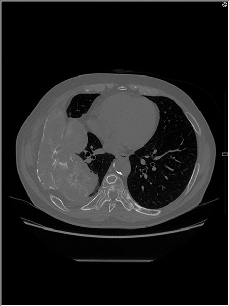 An axial CT image shows the extra-osseous tumor with calcification and cortical destruction of the right seventh rib.