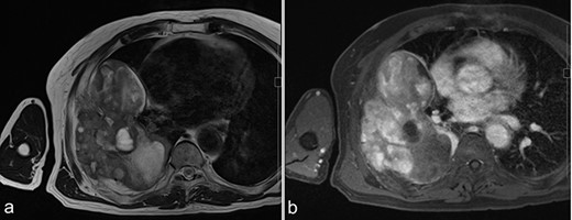 MRI before surgery. (a) T2-weighted MR image shows a mixture of lower and higher intensity areas. (b) An enhanced image shows enhancement in the lower intensity area on T2-weighted images.