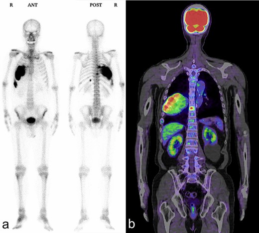 Bone scintigraphy and PET/CT shows an increased uptake in the right seventh and ninth ribs and ninth thoracic vertebral body. (a) Bone scintigraphy; (b) PET/CT.