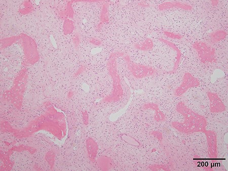 Histologic analysis of the biopsy shows characteristics of fibrous dysplasia with irregular osseous trabeculae of immature bone with no osteoblastic rimming.
