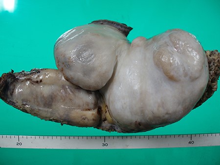 Photographs of resected tumor-like lesion.