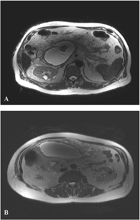 Axial T2-weighted MR image. A. WOPN: large pancreatic collection with hyperintense fluid and hypointense non-liquefied components (debris) pressing inferior vena cava. B. Peripancreatic pseudocysts.