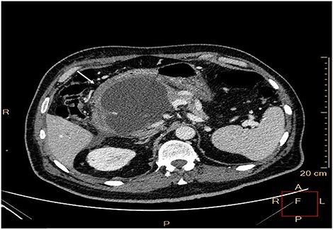 Contrast-enhanced CT. Large walled-off pancreatic necrosis in the pancreatic head, pressing inferior vena cava and duodenum (white arrow).