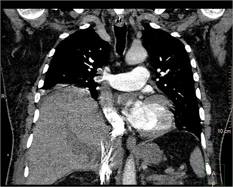 CTPA. Pulmonary embolism. Filling defect (white arrow) of the upper lobar artery (truncus anterior) and the descending interlobar artery.