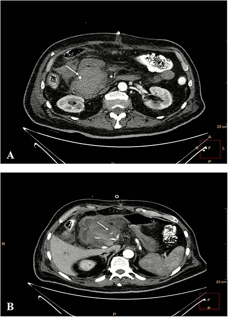 Contrast-enhanced CT in arterial phase. A pseudoaneurysm of gastroduodenal artery with a diameter of 9 mm (white arrow). B. Smaller pseudoaneurysm of a branch of gastroduodenal artery (white arrow).