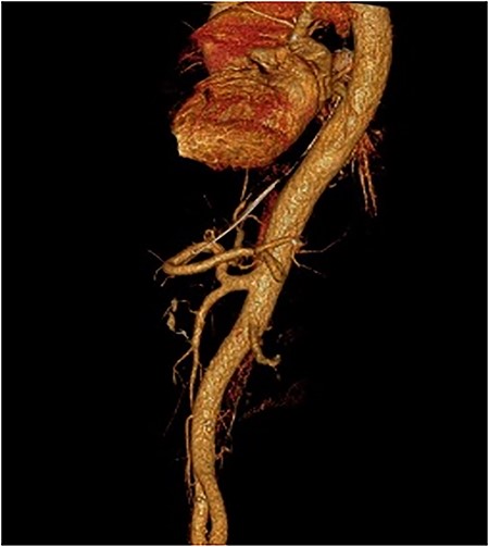 3D-CTA. Celiac-mesenteric trunk.