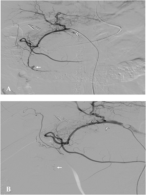 Digital subtraction angiography. A. Pseudoaneurysm of gastroduodenal artery (arrow) and a branch of it (arrow head). B. Postembolization images showing absence of blood flow into the pseudoaneurysms.