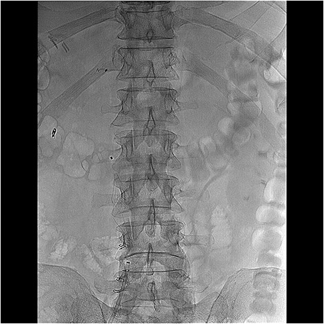 Placement of retrievable inferior vena cava filter.