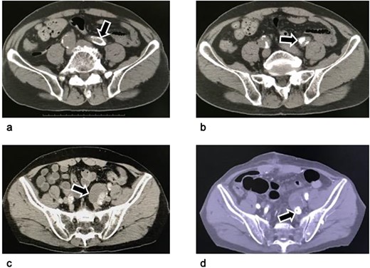 Computed tomography of an isolated internal iliac artery aneurysm. (a–c): Images before the operation: An isolated internal iliac artery aneurysm on the left with a diameter of 36 mm can be seen. The left common iliac artery and the neck of the left internal iliac artery aneurysm were severely calcified (arrows). (d) Image four months postoperatively: The aneurysm sac has become smaller because its wall was resected as much as possible. The vascular plug in the internal iliac artery is visible distal to the aneurysm (arrow).