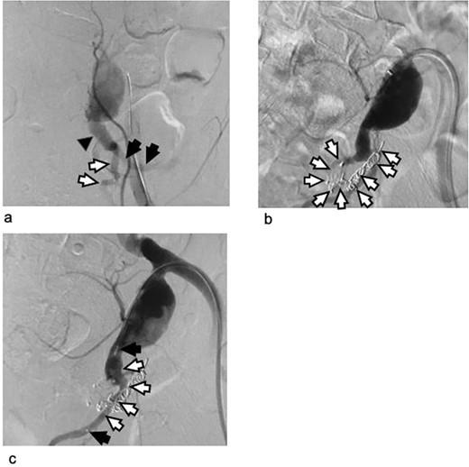 Arteriogram of the left internal iliac artery during the embolization procedure as the first stage of hybrid intervention. (a) Arteriogram before embolization: The left internal iliac artery stem distal to the aneurysm (black triangle) and the anterior (white arrows) and posterior division of the internal iliac artery (black arrows) are shown. (b) Arteriogram after coiling of the posterior division of the left internal iliac artery: Metal coils are visible from the posterior division of the left internal iliac artery to the superior gluteal artery. The microcoil was used because it provides good control in these narrow and tortuous arteries. (c) Arteriogram after vascular plug deployment: The left internal iliac artery stem and its anterior division were embolized using an Amplatzer vascular plug because they were wide and straight enough to insert the 5 Fr guiding catheter. Triangles: the vascular plug. The black arrows indicate the tip of the plug. The blood flow in the artery persisted after the plug had been deployed. The completion of embolization with metal devices needs time.