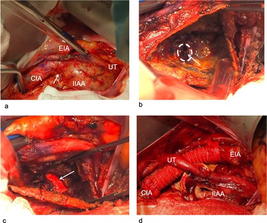 Intraoperative findings during the open procedure as the second stage of hybrid intervention. (a) Dissection of the vessels proximal to the internal iliac artery aneurysm: We clamped the common iliac artery and external iliac artery for proximal control. The neck of the internal iliac artery aneurysm was very short (arrow). (b) Without surgical clamping of the distal branches, we opened the aneurysm. The origin of the distal internal iliac artery and the tip of the vascular plug obstructing it are visible. No bleeding into the internal iliac artery aneurysm can be seen. The first-stage embolization had completely controlled the distal blood flow. Arrow: the tip of the vascular plug. Circle: the orifice of the internal iliac artery distal to the aneurysm. (c) We ligated the origin of the distal internal iliac artery with a 4–0 pledgeted suture to avoid dislodgement of the vascular plug and delayed bleeding. Arrow: one of the two pledgets used in the ligation. (d) The common iliac artery could not be directly closed. We interposed the artery for proximal repair. The aneurysm wall was resected as much as possible.