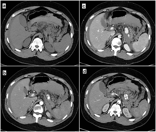 Abdominal CT scan at the onset of patient’s hemodynamic instability: (a) CT-image before the iv contrast administration shows the aneurysm (arrow) and free fluid (blood) into the infraperitoneal space and peritoneal cavity (arrowhead). (b, c and d) Post contrast CT-images (arterial phase) reveal the ruptured aneurysm clearly the free blood collection into the infraperitoneal space (arrowhead).