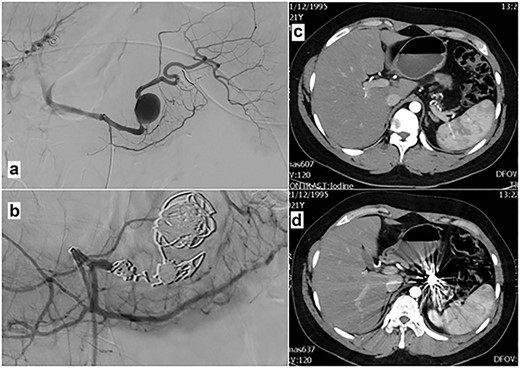 Angiography after selective catheterization of the splenic artery (a) reveals the ruptured aneurysm. Angiography after the micro coil and glue embolization of the aneurysm and the proximal splenic artery (b) shows complete obstruction of the lumen. (c and d) Post contrast CT-images (arterial phase) 8 months after splenic artery aneurysm embolization, show complete elimination of aneurysm and preservation of the collateral arteries to the spleen.