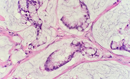 Microscopic examination reveals within the mucin pools are clusters and strips of malignant intestinal type epithelium (HE 40 × ).