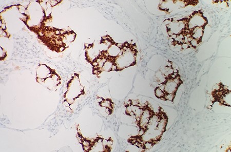 The immunohistochemical stain shows that tumor cells are positive for CDX2 (IHC 20 × ).