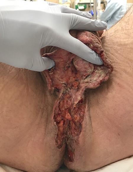 Operative photo. Extent of debrided soft tissue at time of initial intervention.