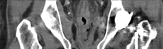 Coronal CT image demonstrating contained, localised rectal perforation secondary to enema injury.