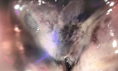 Sigmoidoscopic still of site of rectal injury. Site of perforation marked with Asterix*.