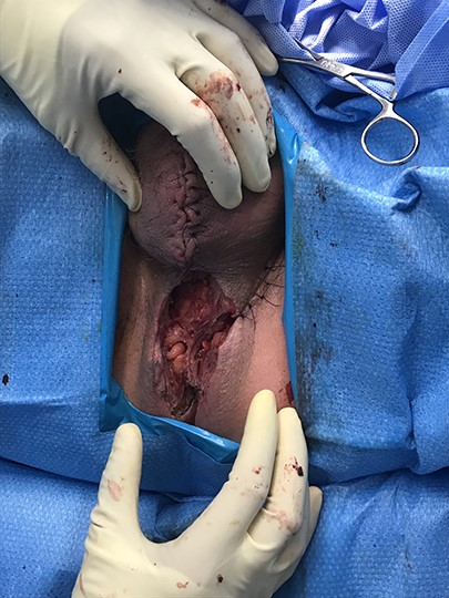 Operative photo. The wound at final operative inspection was partially closed. A negative pressure wound management device was placed to the remaining defect. A diverting colostomy was created in order for the management device to be undisturbed, as the remaining defect was around the anus.