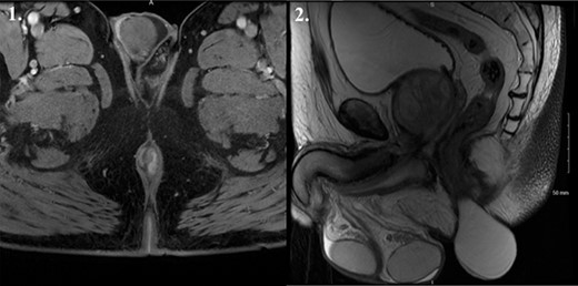 MRI T2 weighted imaging suggestive of a 7 cm × 5 cm × 5 cm fluid-filled structure arising in the intersphincteric plane. 1. Coronal view. 2. Sagittal view.
