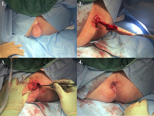 Surgical management of the large intersphincteric epidermoid inclusion cyst. 1. Examination under anaesthesia. 2. Delineation of the origin of the cyst in the intersphincteric plane. 3. Surgical excision of the cyst and haemostasis. 4. Interrupted suture repair of the perineal defect.