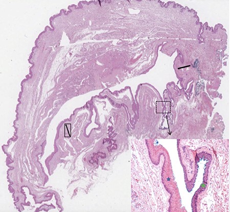 Microscopic overview of the surgical specimen showing a large hybrid epidermal inclusion cyst (black arrows) lined by squamous epithelium (blue star) with areas of transitional epithelium (green star; haematoxylin and eosin stains).