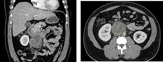 Abdominal CT scan with retroperitoneal mass 72 × 63 mm.