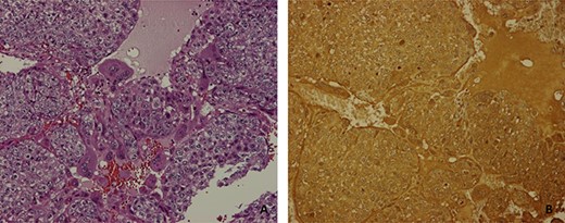 (A) mononucleated trophoblast cells and multinucleated synciciotrophoblasts with a haemorrhagic focus (H&E 10×); (B) β-hCG immunoexpression in neoplastic cells (H&E 10×).