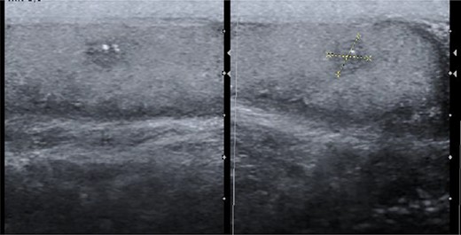 Scrotal ultrasound with a heterogeneous nodule with microcalcifications.