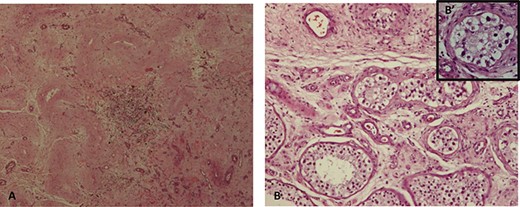 (A) fibrous scar with focus of lymphoplasmacytic inflammatory cells and hyalinized ghost seminiferous tubules; (B) sclerotic and atrophic seminiferous tubules peripheral to the scar (H&E 10×), (B′) some with germ cell neoplasia in situ (H&E 40×).