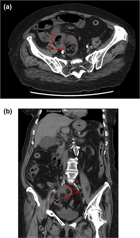 CT axial (a) and coronal (b) views showing loop of strangulated small bowel with surrounding fat stranding and free fluid (red arrows).