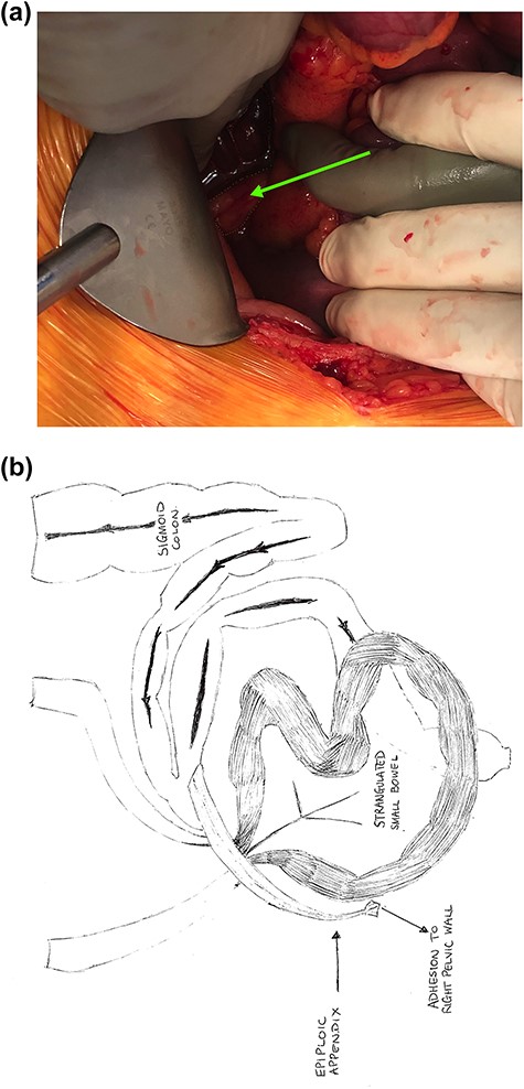 (a) Intraoperative image demonstrating loop of strangulated small bowel (red border) and band adhesion to the right pelvic wall (green border and arrow); and (b) schematic depiction of the closed loop obstruction.