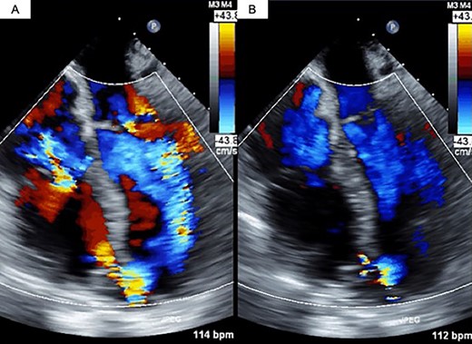 Transesophageal echocardiography findings. (A) Pre-PAB; (B) post-PAB