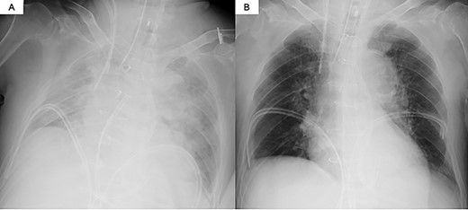 Chest radiography. (A) Pre-PAB; (B) post-PAB