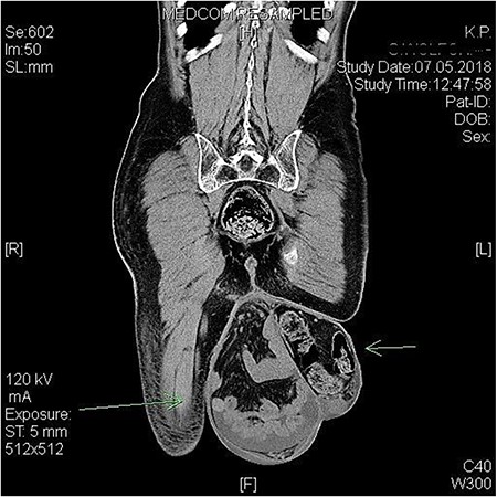 Preoperative CT scan showing the bilateral giant scrotal hernia with massive shift of intestine into scrotum.