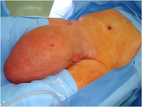 Clinical aspect of the giant inguinoscrotal hernia.