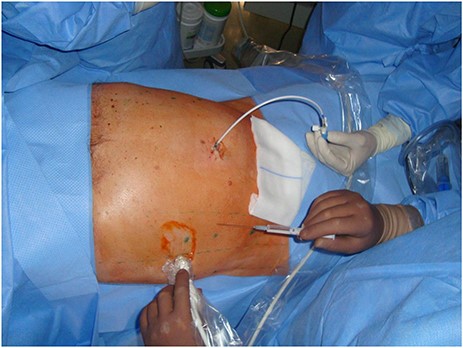 Intramuscular injection of botulinum toxin under sonographic guidance. The insufflation catheter has been already placed.