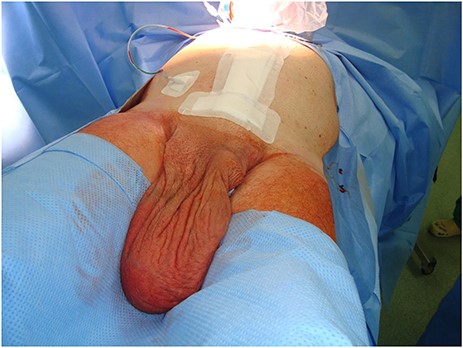 Aspect of abdomen and scrotum after completion of surgical repair.