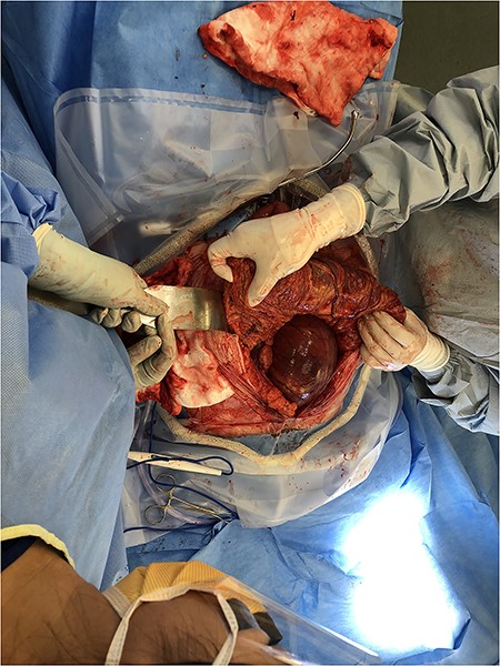Sigmoid Volvulus pre-decompression within the supracolic compartment.