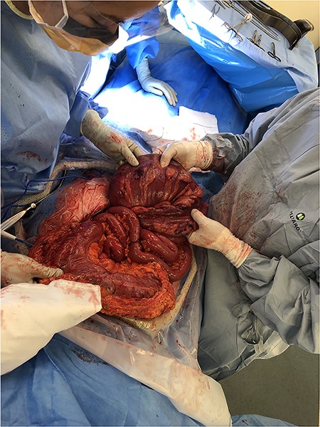 Sigmoid colon herniating through transmesocolon defect.