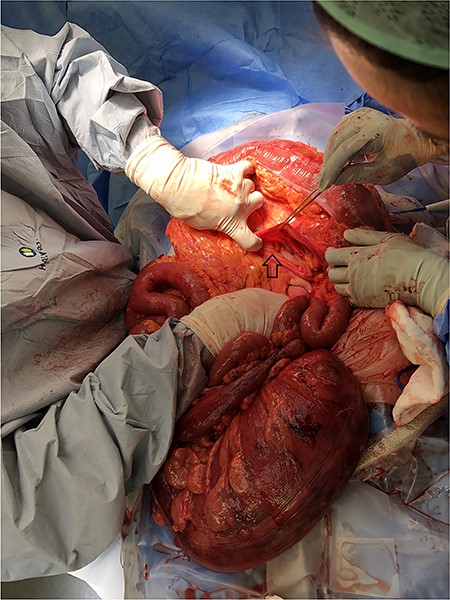 Arrow showing transmesocolic defect.