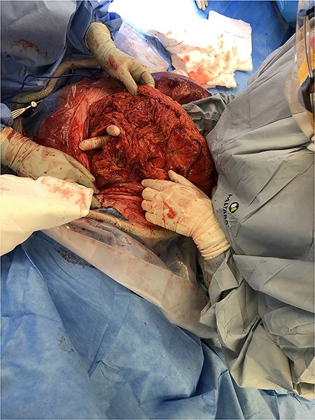 Surgeon demonstrating transmesocolic defect.