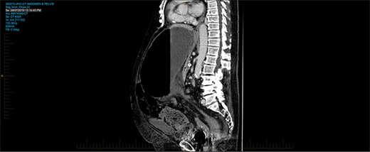 CT pm sagittal view showing sigmoid colon herniating through trasn-mesocolon defect.