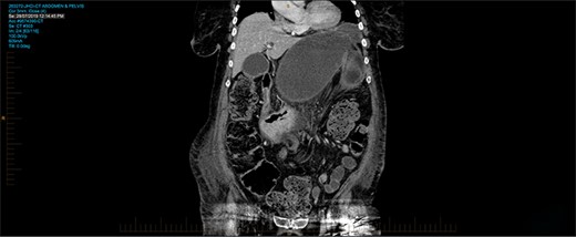 CT on coronal view showing sigmoid colon in the supracolic compartment.