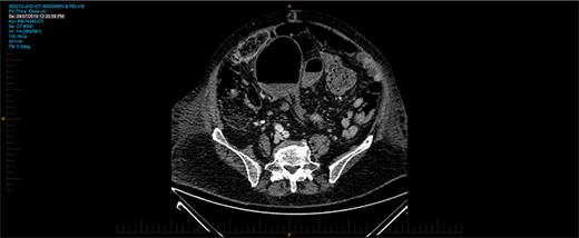 CT on axial view showing twisting of sigmoid colon resulting in volvulus.