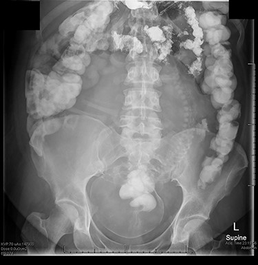 Abdominal X-ray with Gastrografin oral contrast media seen in the large bowel, with her 30-week-old baby seen in the lower abdomen and pelvis.