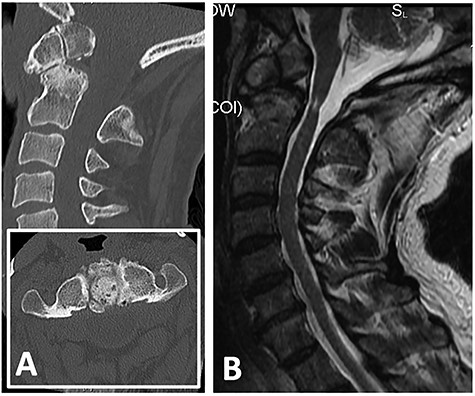 (A) CT showing non-union between odontoid process with body of axis (C2) and absence of posterior arch of atlas (C1); (B) T2-weighted MRI revealing cord signal change and atrophy at level of C1/2 suggestive of myelomalacia.