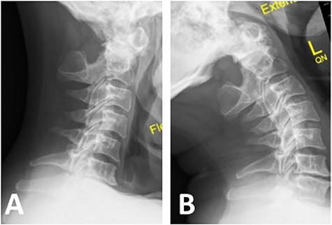 Note the absence of posterior arch of atlas (C1); (A) flexion X-ray revealed antero-inferior translation of atlas (C1) on axis (C2); (B) extension X-ray revealed postero-superior translation of atlas (C1) on axis (C2).