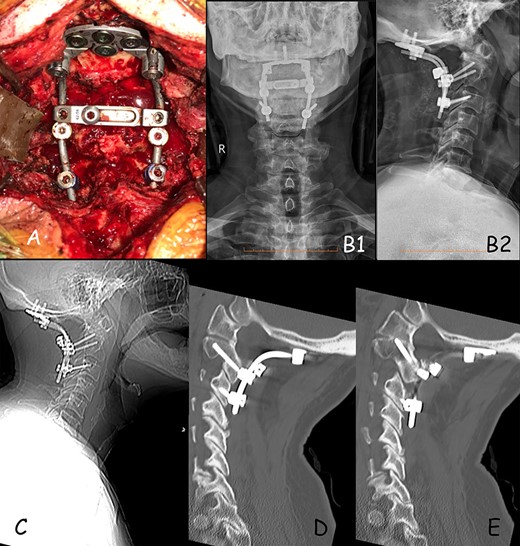(A) Intra-operative positioning of occipital plate and screws construct. (B) 1-month post-op X-ray, (B1) anterior–posterior and (B2) lateral X-ray. (C) 12-months post-op lateral X-ray showing good positioning of construct. (D) Sagittal CT demonstrating good positioning of construct on the right side. (E) Sagittal CT demonstrating good positioning of construct on the left side.